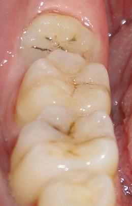 什么是智齿？为什么会长智齿？它有什么危害？一定要拔掉吗？