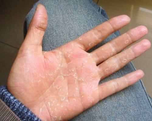 手掌、手指蜕皮严重，是天气干燥还是手癣？五大偏方帮助你不复发