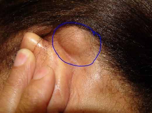 皮肤科医生：耳朵后面长了疙瘩，4个原因别忽视！