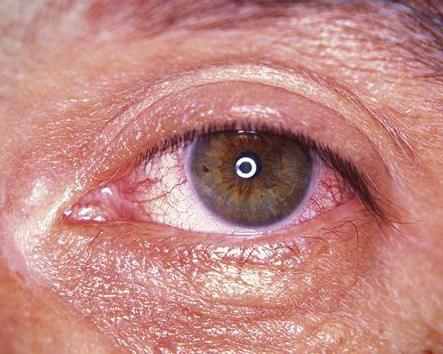 眼睛出现红血丝是怎么回事？教你几个实用小方法帮助眼睛赶走疲劳