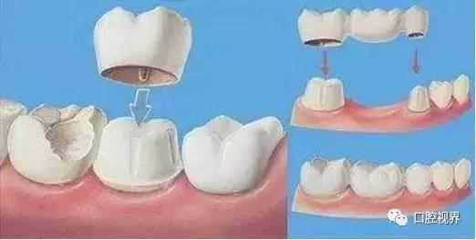 如何选择牙齿修复材料？看这篇文章就够了