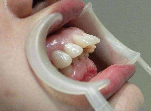 医生来告诉你，到底宝宝为啥会龅牙？怎样才能远离“地包天”？