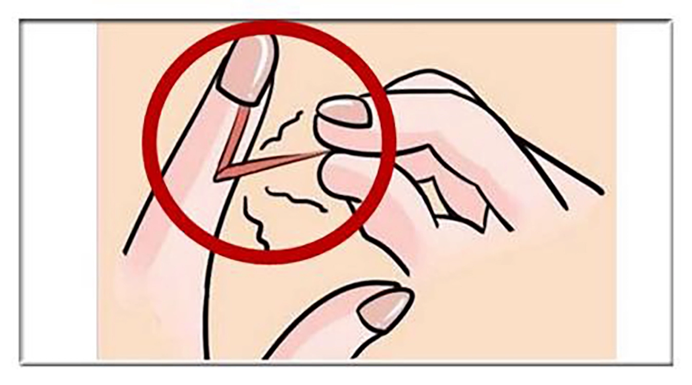 指甲倒刺是缺维生素吗_倒刺引发的指甲边发炎_
