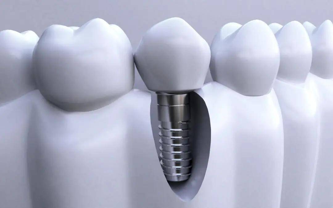 牙齿种和镶牙__镶牙齿和种植牙的区别