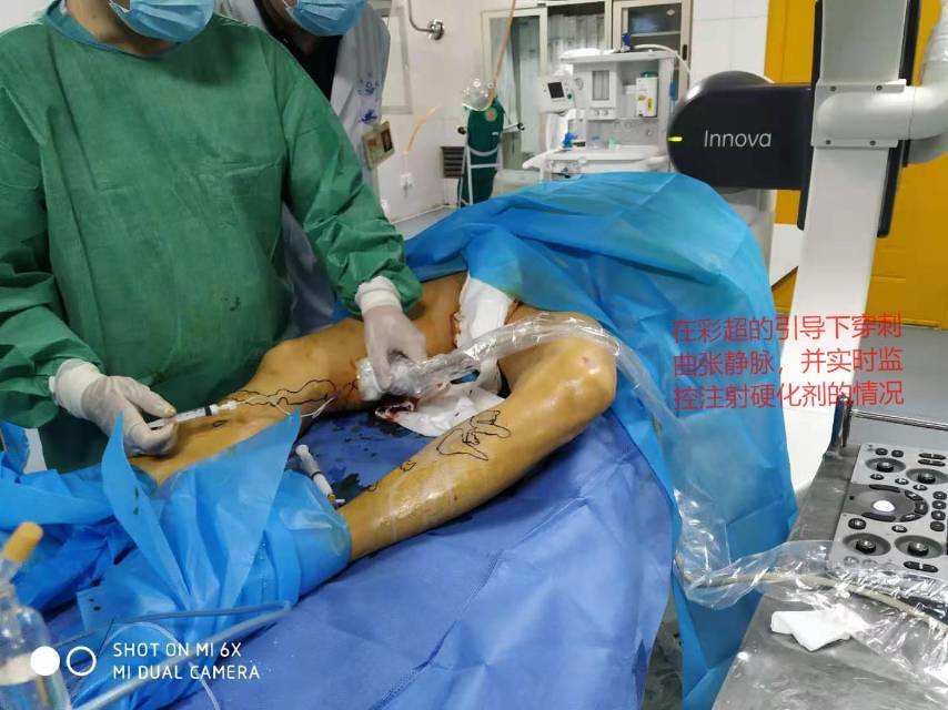 _下肢静脉曲张微创手术视频_静脉手术下肢微创曲张费用多少