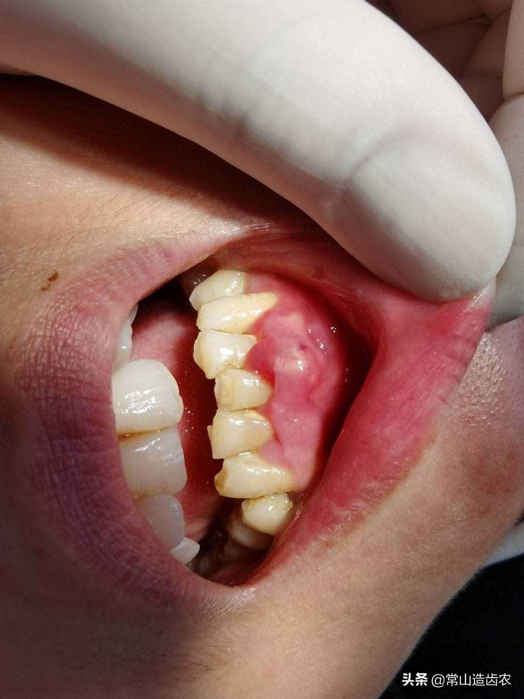 治疗牙周炎症的偏方__治疗牙周炎的特效