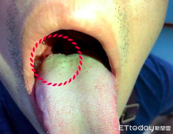喉咙中间的小舌头_舌头中间靠近喉咙处有小疙瘩_
